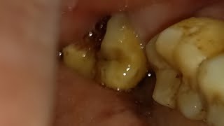 Badly Decayed Lower Molar Eight extraction [upl. by Willamina555]