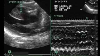 Tetralogy of Fallot with Vertically Oriented PDA [upl. by Hiltner]