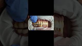 Lower implant molar bridge bite check with Bausch 40 micron articulating paper test shorts [upl. by Haimes]