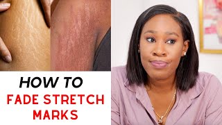 How to REMOVE STRETCH MARKS Safely  Stretch marks removal tips  Bio Oil for stretch marks [upl. by Edie]