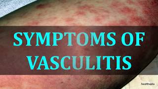 SYMPTOMS OF VASCULITIS [upl. by Bred]