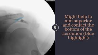 1 Minute Shoulder Subacromial Bursa Injection [upl. by Eliak810]