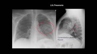 Chest Xray Cases 1 [upl. by Lauter88]