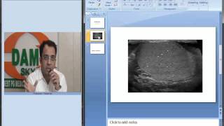 Radiology Spotters Part 18 Testicular microlithiasis [upl. by Ocire]