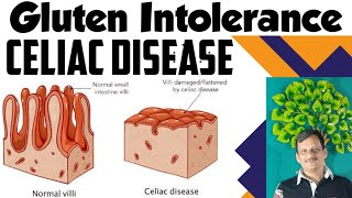 What is Celiac Disease  What can I eat as glutenfree diet  Foods to avoid in Celiac ajaykaushik [upl. by Adnilem]