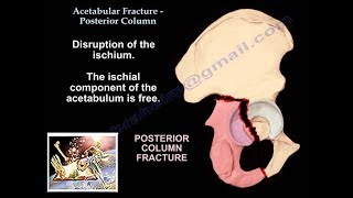 Acetabular Fracture Posterior Column Fracture  Everything You Need To Know  Dr Nabil Ebraheim [upl. by Atnauq152]