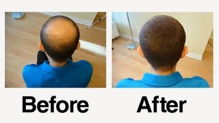 Stephens Incredible Hair Loss Story [upl. by Fulvi]