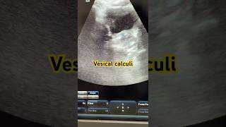 Vesical Calculi Cystoliths videos reels urinarybladder stones calculus cystitis ultrasound [upl. by Neela]