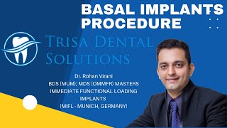 Basal Implants Procedure Step By Step Explained  5 दिन में FIXED TEETH  Basal Implants Expert [upl. by Bonnibelle82]