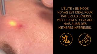 Tutoriel n°6  Traitement dun angiome stellaire avec le laser Elite par le Dr Patarin [upl. by Ilecara77]