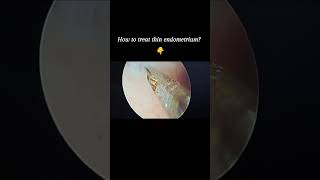 Chronic endometritis endometriosis fertility infection pregnancy uterus hysteroscopy [upl. by Heimer389]