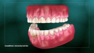 Understanding Tooth Wear [upl. by Qidas]