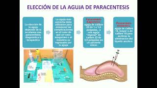 Paracentesis Abdominal [upl. by Groos314]