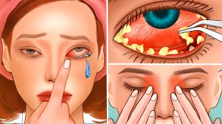 ASMR dry eye stone removal and conjunctivitis Treatment  Relaxing Eye Care animation [upl. by Heshum8]