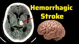 Hemorrhagic Stroke Brain bleed  CT Brain Radiology  Hemorrhage [upl. by Armalda]