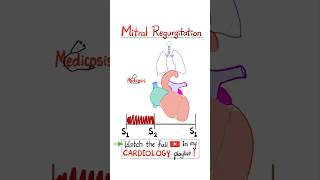 Mitral Regurgitation MR  Valvular Heart Disease VHR…cardio anatomy mbbs science nclex [upl. by Ashmead]