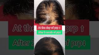 before and after  prp for female patterned hair loss  shorts [upl. by Cates]