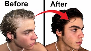 How To Stop Balding  Full hair loss guide [upl. by Einnov]