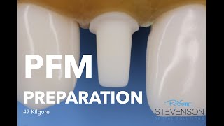 PFM Preparation on Tooth 7 Kilgore  Stevenson Dental Solutions [upl. by Thurstan880]