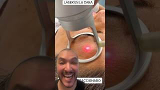 Láser en la Cara  laser laserfacial [upl. by Anier]