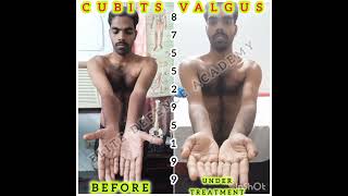 quotSuccessful Cubitus Valgus correction by Dr Manish Bansal at Elite Defence Academy Meerutquot [upl. by Ived236]