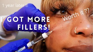 💉FILLER VLOGI Got My FILLERS REDONE 1 YEAR UNDER EYE FILLER UPDATE😮‍💨 [upl. by Micah]