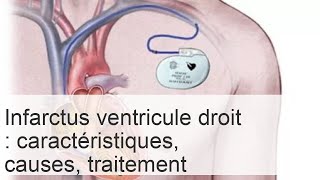 Infarctus du ventricule droit  symptômes traitement et prévention [upl. by Ritch]