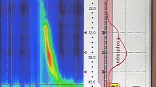 esophageal manometry [upl. by Oswald]