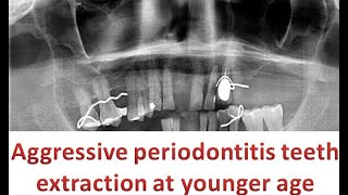 Aggressive periodontitis  Extraction of teeth in upper full arch [upl. by Eelrahs]