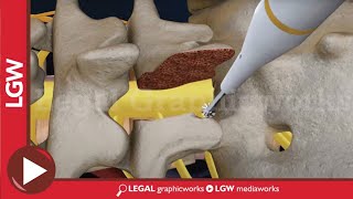 L5S1 Lumbar Discectomy and Fusion Surgery 3D animation [upl. by Naivatco]