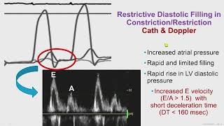 Constrictive Pericarditis [upl. by Neerroc]