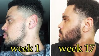 My Minoxidil Beard Journey  Week 17  Pre Minox Photos [upl. by Sapphire]