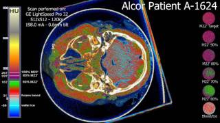 1624 Baglivo CT Analysis [upl. by Rodablas458]