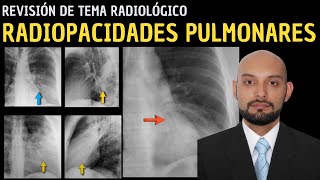 Revisión de Tema 88 Radiopacidades pulmonares [upl. by Ramat735]