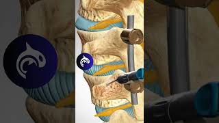 See how a Lumbar Fusion of the Spine works in 3D animation backpain stem spine [upl. by Merras802]