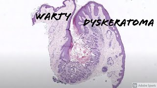 Warty Dyskeratoma 5Minute Pathology Pearls [upl. by Hniv]