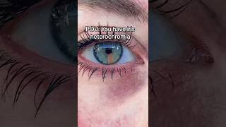 IRIS Heterochromia coloured EYE 👁️ 🧡 eyes rare aesthetic [upl. by Tooley]