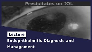 Endophthalmitis Diagnosis and Management [upl. by Anahcar]