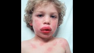 Anaphylaxis and Acute Allergic reaction  How to Help [upl. by Erena]