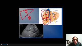 SEGMENTACIÓN HEPÁTICA POR ULTRASONIDOS [upl. by Enerahs]