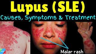 Lupus Systemic Lupus Erythematosus  SLE – Symptoms Causes Diagnosis Treatment amp Complications [upl. by Bradski762]