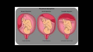 PLACENTAL ABRUPTION [upl. by Erdrich]