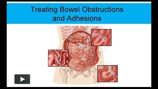 Treating Bowel Obstructions and Adhesions NonSurgically [upl. by Eniksre]