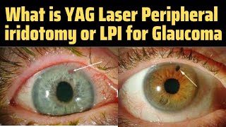 Peripheral Iridotomy  Lpi Eye Procedure  Yag Pi Laser  Lpi Eye Surgery  Glaucoma Treatment [upl. by Nnaylrebmik]