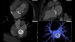 4D viewer for Aortic amp Mitral valve TAVI protocol [upl. by Divadleahcim]