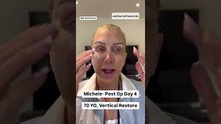 DAY 4 of Facelift Healing amp Recovery How its ACTUALLY Going [upl. by Tavi46]