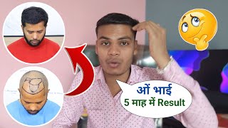 Hair Transplant 5 Months Result Hair Transplant In Bhopal QHT Taknik Hair Transplant Results Bhopal [upl. by Sikleb]