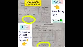 Satisfactory OVULATION STUDY results post Ayurvedic treatment [upl. by Inaoj]