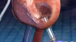 Left Ventricular Assistive Device  3D Medical Animation  ABP © [upl. by Eemiaj]