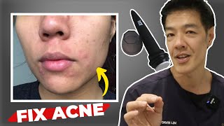 Getting Rid of Acne Scars at Home  Microneedling  Dr Davin Lim [upl. by Seyler]